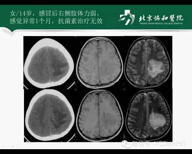 【PPT】炎性脱髓鞘疾病的MR诊断