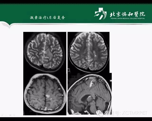 【PPT】炎性脱髓鞘疾病的MR诊断