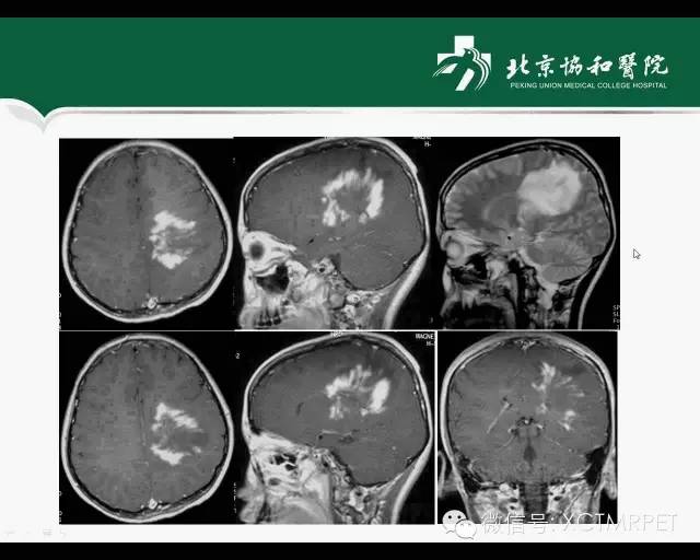 【PPT】炎性脱髓鞘疾病的MR诊断