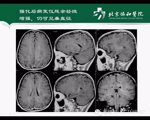 【PPT】炎性脱髓鞘疾病的MR诊断