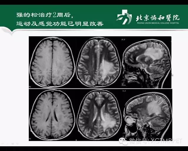 【PPT】炎性脱髓鞘疾病的MR诊断