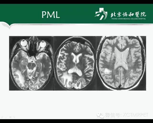 【PPT】炎性脱髓鞘疾病的MR诊断