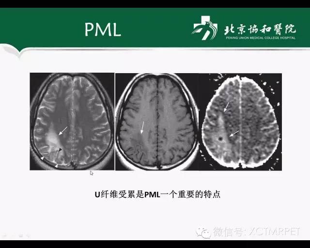 【PPT】炎性脱髓鞘疾病的MR诊断