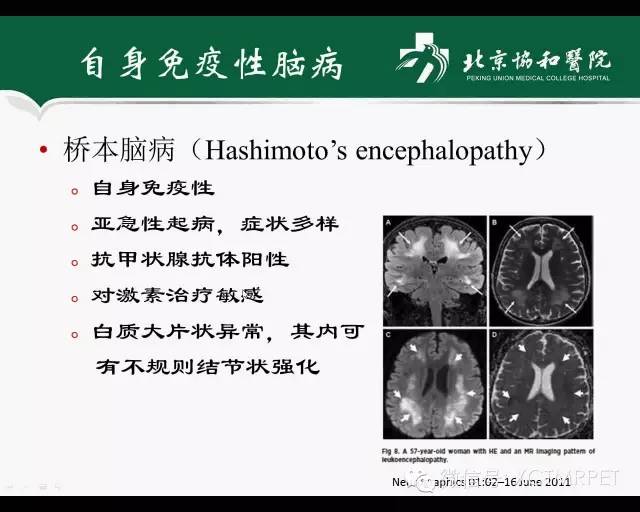 【PPT】炎性脱髓鞘疾病的MR诊断