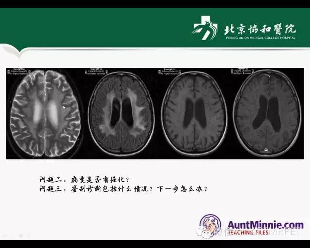 【PPT】炎性脱髓鞘疾病的MR诊断