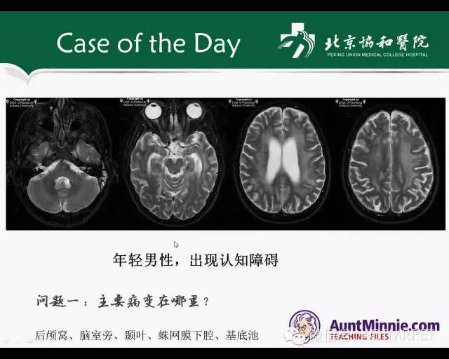 【PPT】炎性脱髓鞘疾病的MR诊断