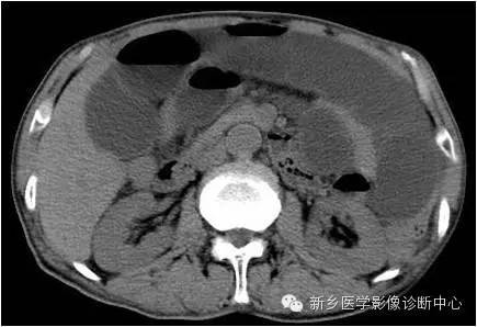 【病例】高位小肠梗阻1例X线CT影像表现 【病例】高位小肠梗阻1例X线CT影像表现