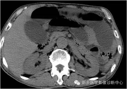 【病例】高位小肠梗阻1例X线CT影像表现 【病例】高位小肠梗阻1例X线CT影像表现