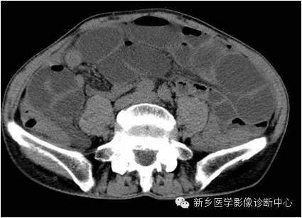 【病例】高位小肠梗阻1例X线CT影像表现 【病例】高位小肠梗阻1例X线CT影像表现