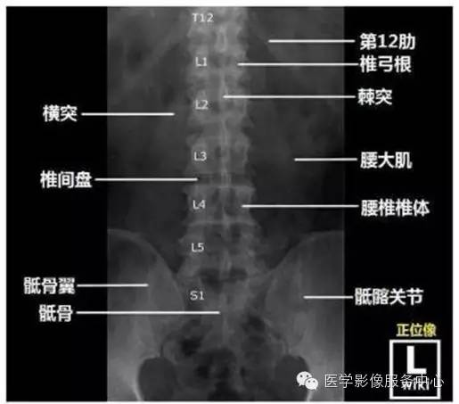 移行椎——如何判断骶椎腰化/腰椎骶化 移行椎——如何判断骶椎腰化/腰椎骶化