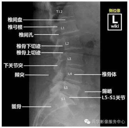 移行椎——如何判断骶椎腰化/腰椎骶化