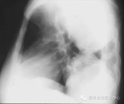 【病例】胸膜孤立性纤维瘤1例CT影像表现 【病例】胸膜孤立性纤维瘤1例CT影像表现