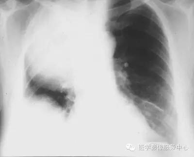【病例】胸膜孤立性纤维瘤1例CT影像表现 【病例】胸膜孤立性纤维瘤1例CT影像表现