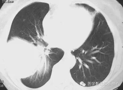 【病例】胸膜孤立性纤维瘤1例CT影像表现 【病例】胸膜孤立性纤维瘤1例CT影像表现