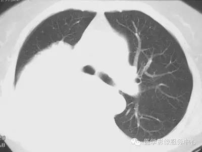【病例】胸膜孤立性纤维瘤1例CT影像表现 【病例】胸膜孤立性纤维瘤1例CT影像表现