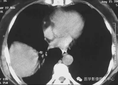 【病例】胸膜孤立性纤维瘤1例CT影像表现 【病例】胸膜孤立性纤维瘤1例CT影像表现