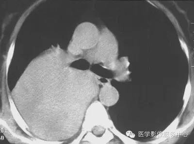 【病例】胸膜孤立性纤维瘤1例CT影像表现