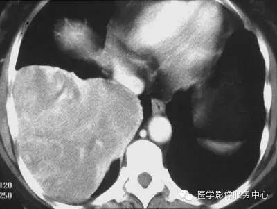 【病例】胸膜孤立性纤维瘤1例CT影像表现 【病例】胸膜孤立性纤维瘤1例CT影像表现