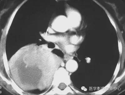 【病例】胸膜孤立性纤维瘤1例CT影像表现 【病例】胸膜孤立性纤维瘤1例CT影像表现