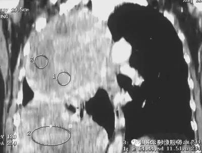 【病例】胸膜孤立性纤维瘤1例CT影像表现 【病例】胸膜孤立性纤维瘤1例CT影像表现