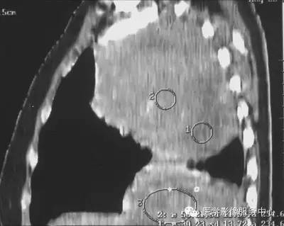 【病例】胸膜孤立性纤维瘤1例CT影像表现 【病例】胸膜孤立性纤维瘤1例CT影像表现