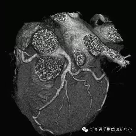【病例】胸部血管（含冠脉）解剖+详细标注