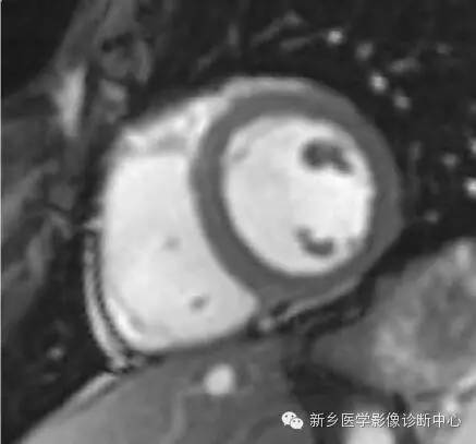 【病例】胸部血管（含冠脉）解剖+详细标注