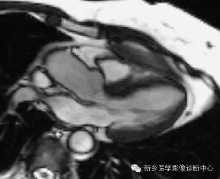 【病例】胸部血管（含冠脉）解剖+详细标注