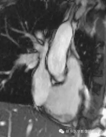 【病例】胸部血管（含冠脉）解剖+详细标注