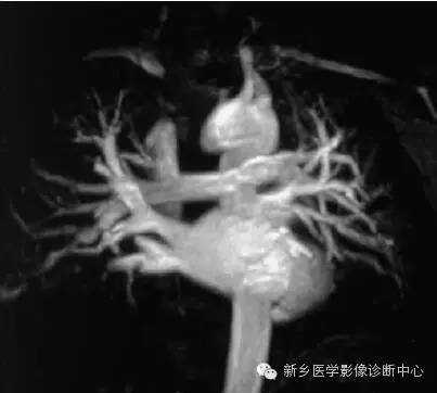 【病例】胸部血管（含冠脉）解剖+详细标注