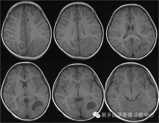 【病例】多形性黄色星形细胞瘤1例MR影像表现