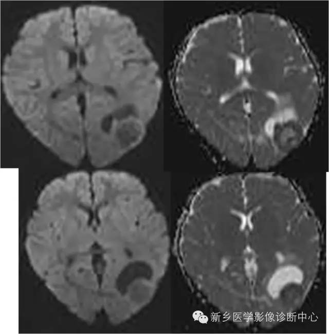 【病例】多形性黄色星形细胞瘤1例MR影像表现 【病例】多形性黄色星形细胞瘤1例MR影像表现