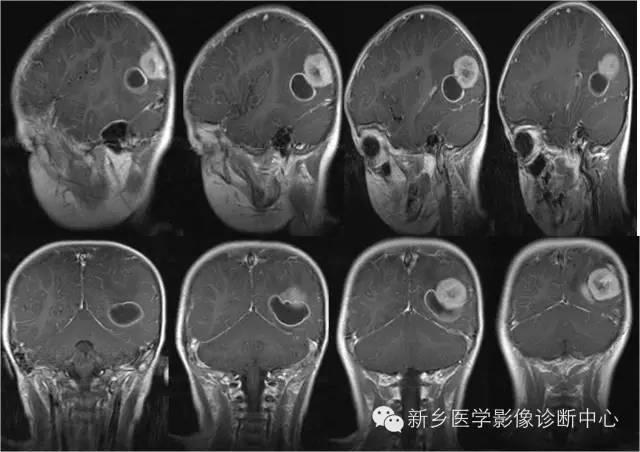 【病例】多形性黄色星形细胞瘤1例MR影像表现 【病例】多形性黄色星形细胞瘤1例MR影像表现