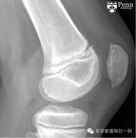 【病例】髌骨骨软骨病1例X线影像表现 【病例】髌骨骨软骨病1例X线影像表现