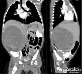 【病例】肾母细胞瘤1例CT影像表现 【病例】肾母细胞瘤1例CT影像表现