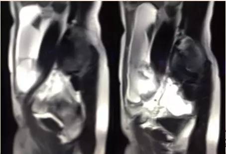 【病例】黄体血肿1例MR影像表现 【病例】黄体血肿1例MR影像表现