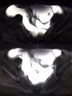 【病例】黄体血肿1例MR影像表现 【病例】黄体血肿1例MR影像表现
