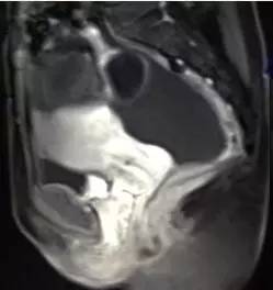 【病例】黄体血肿1例MR影像表现 【病例】黄体血肿1例MR影像表现