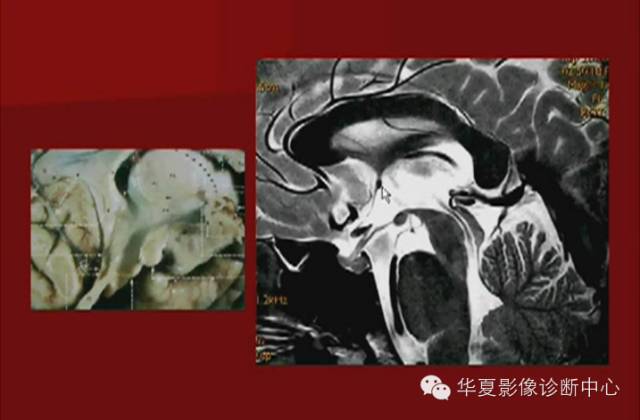 【PPT】下丘脑MR影像诊断