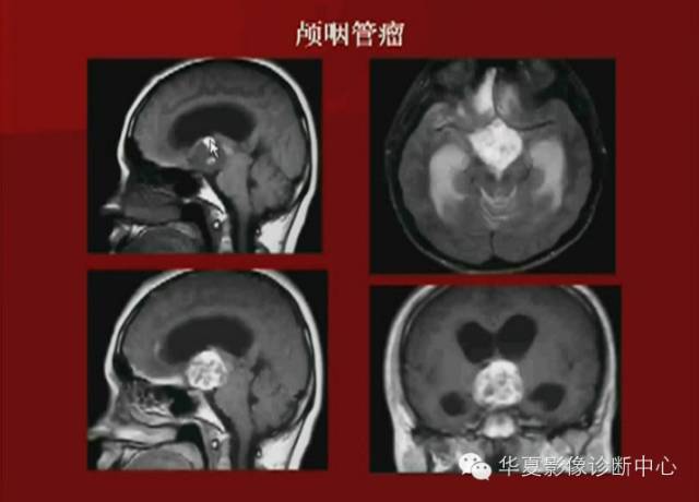【PPT】下丘脑MR影像诊断