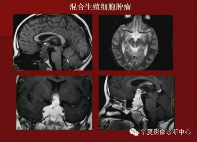【PPT】下丘脑MR影像诊断