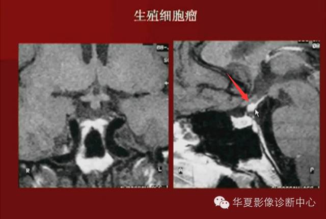 【PPT】下丘脑MR影像诊断