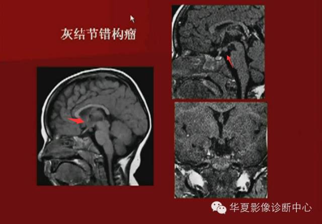 【PPT】下丘脑MR影像诊断