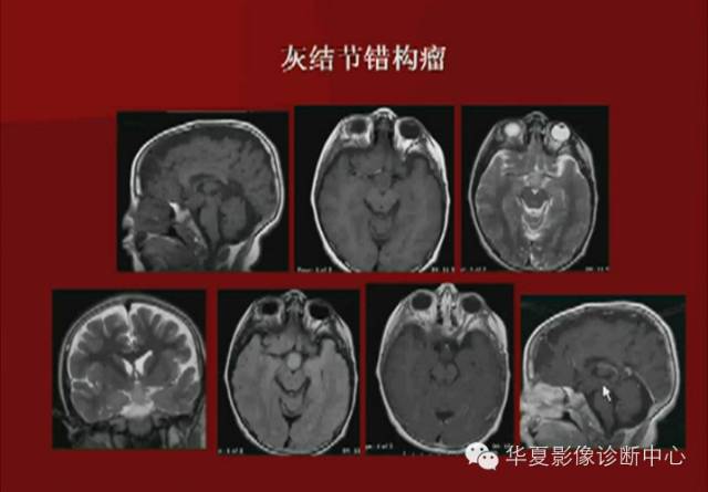 【PPT】下丘脑MR影像诊断