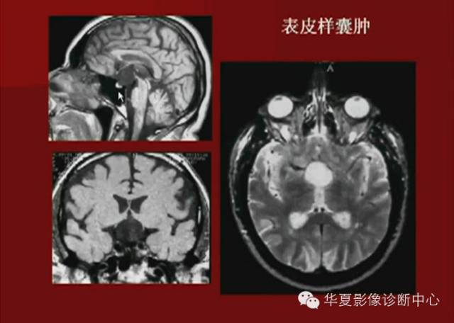 【PPT】下丘脑MR影像诊断