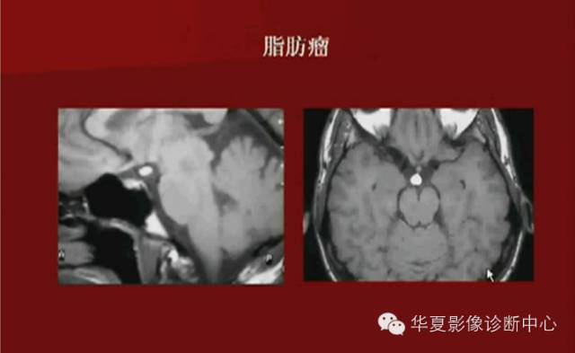 【PPT】下丘脑MR影像诊断