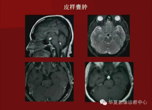 【PPT】下丘脑MR影像诊断