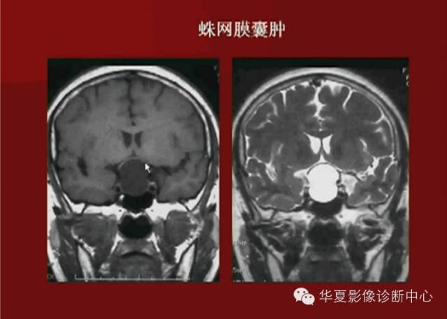 【PPT】下丘脑MR影像诊断
