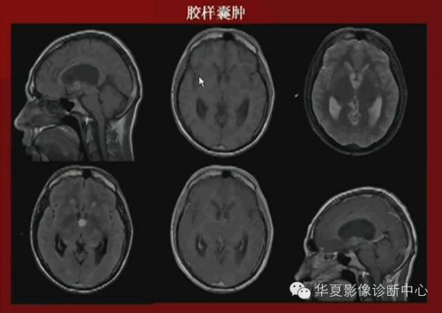 【PPT】下丘脑MR影像诊断