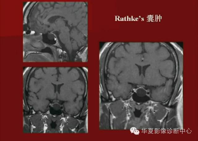 【PPT】下丘脑MR影像诊断